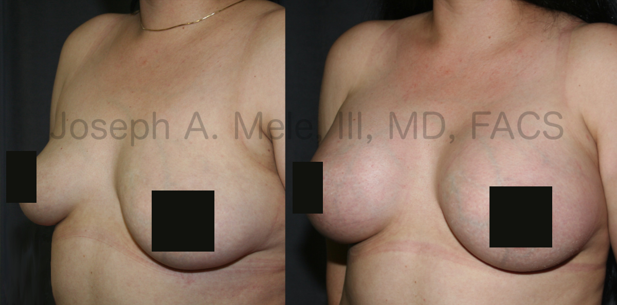 Breast Augmentation Before and After Pictures - Gummy Bear Breast Implants