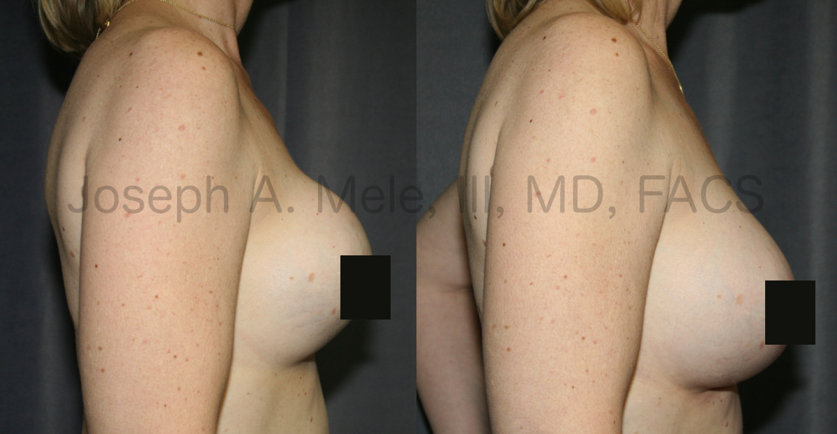 Breast Implant Revision Surgery before and after pictures Breast Revision Surgery for capsular contracture