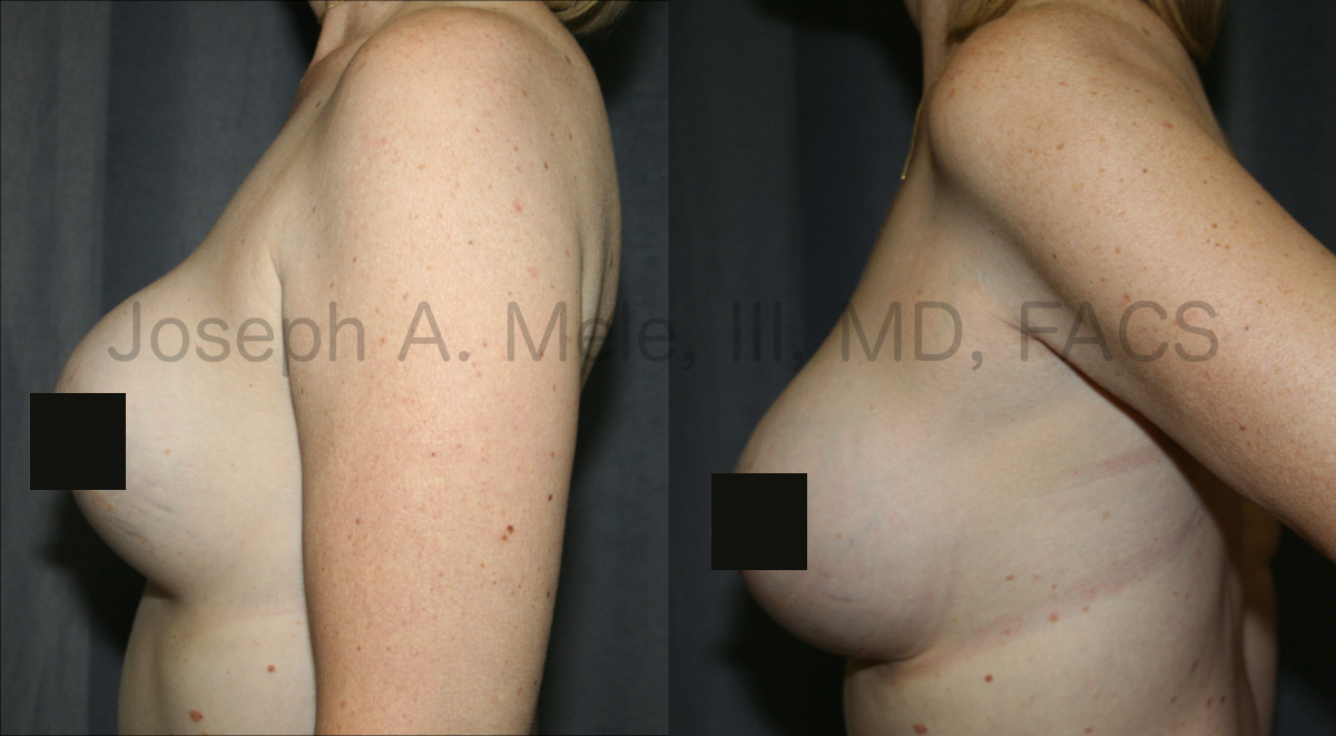 Breast Implant Revision Surgery before and after pictures Breast Revision Surgery for capsular contracture