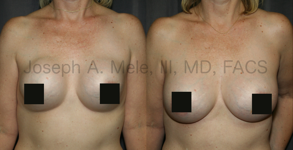 Breast Implant Revision Surgery before and after pictures Breast Revision Surgery for capsular contracture