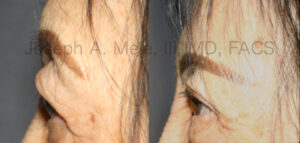 Upper blepharoplasty before and after photos - cosmetic eyelid lift of the upper eyelids