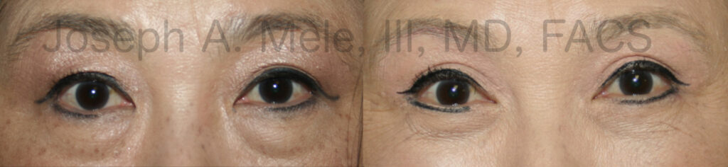 Asian blepharoplasty - double eyelids surgery before and after photos