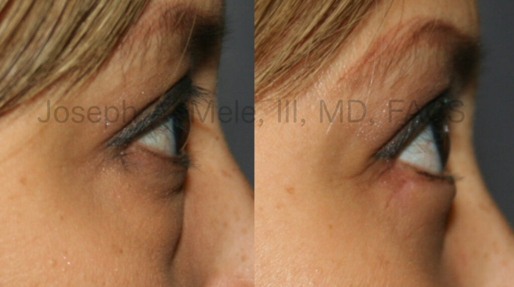 Lower blepharoplasty - cosmetica lower eyelid lift