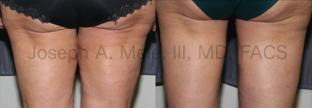 Thigh lift after weight loss retires the thigh gap - before and after pictures