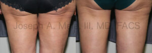 Thigh lift after weight loss retires the thigh gap - before and after pictures
