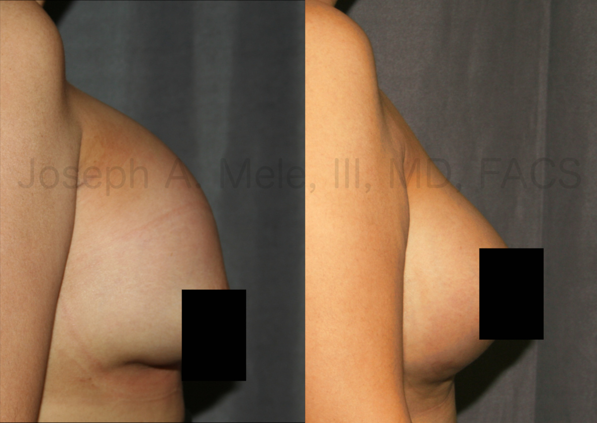 Breast Augmentation Revision Surgery before and after pictures