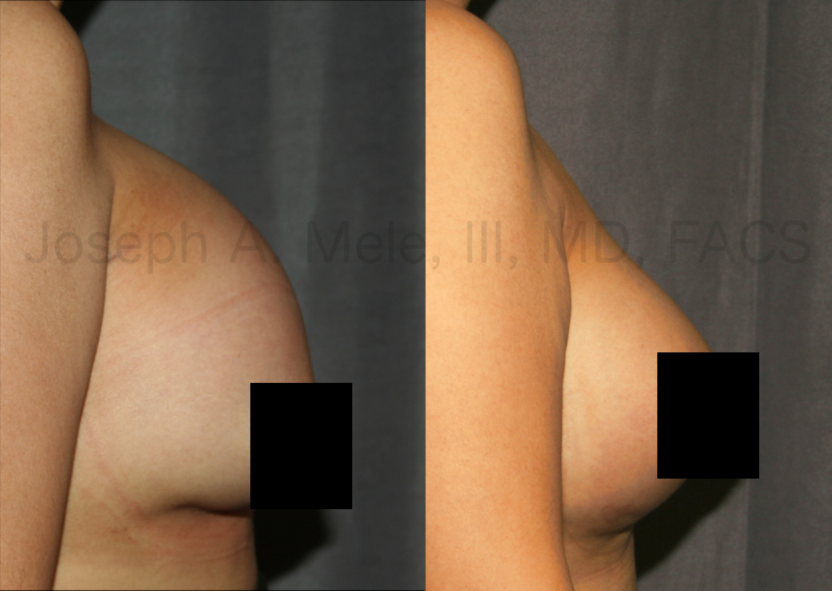 Breast Augmentation Revision Surgery before and after pictures