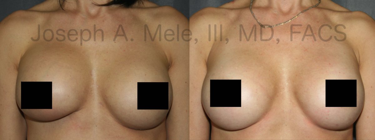 Breast Augmentation Revision Surgery before and after pictures