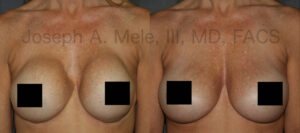 Breast Augmentation Revision Surgery before and after pictures