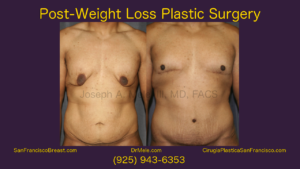 Post Bariatric Plastic Surgery Video - Lower Body Lift, Tummy Tuck with Male Breast Reduction