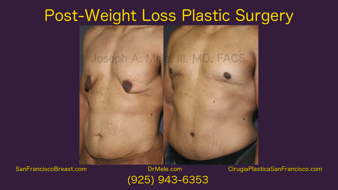 Post Bariatric Plastic Surgery Video - Lower Body Lift, Tummy Tuck with Male Breast Reduction