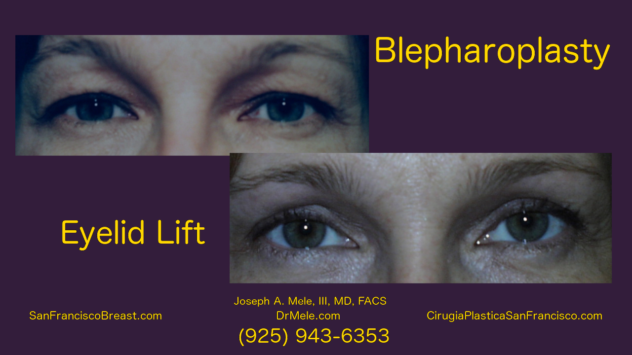 Blepharoplasty Video with before and after pictures and Asian double eyelid surgery