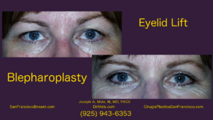 Blepharoplasty Video with before and after pictures and Asian double eyelid surgery