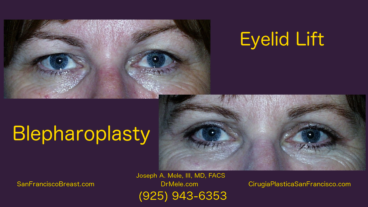 Blepharoplasty Video with before and after pictures and Asian double eyelid surgery