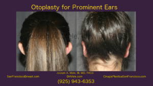 Otoplasty for Prominent Ears - Video presentation with before and after pictures