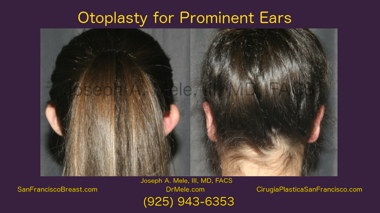 Otoplasty for Prominent Ears - Video presentation with before and after pictures