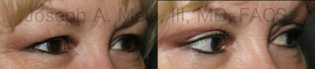 Eyelid Lift (Blepharoplasty) for Tired Eyes before and after photos