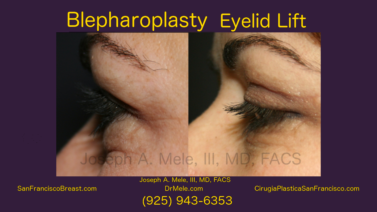 Eyelid Lift (Blepharoplasty) for Tired Eyes before and after photos