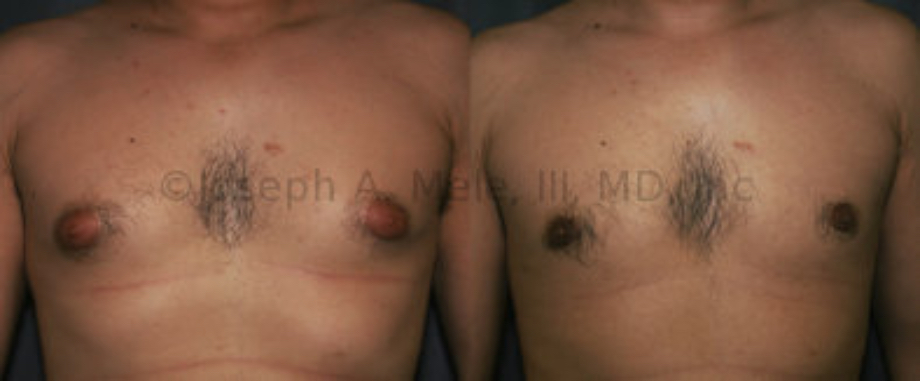 Gynecomastia Reduction Surgery before and after pictures - Liposuction and Gland Resection