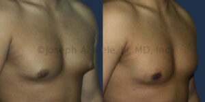 Male Breast Reduction before and after picture (gynecomastia reduction surgery)