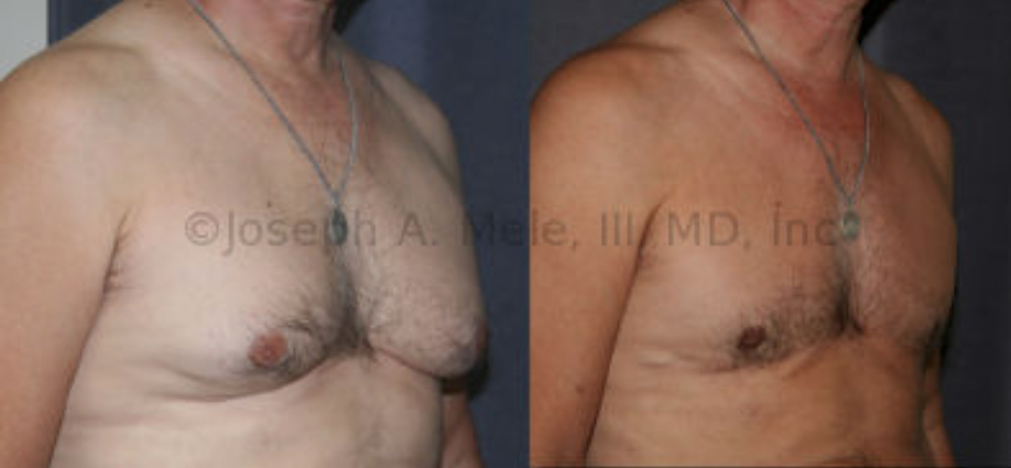 Male Breast Reduction with Inframammary skin excision before and after pictures