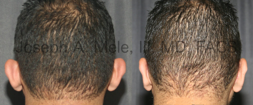 Otoplasty before and after pictures - ear pinning cosmetic ear surgery for prominent ears (man)