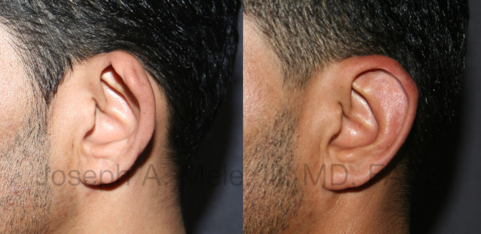 Otoplasty (Cosmetic Ear Surgery & Ear Pinning) SF Bay Area