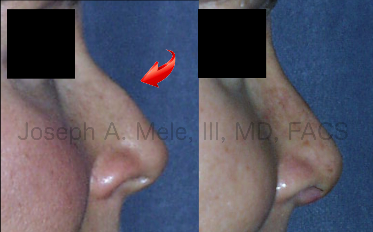 Rhinoplasty before and after pictures one week after cosmetic nasal surgery