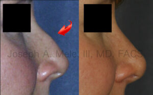 Cosmetic nasal surgery before and after pictures (Cosmetic Rhinoplasty)