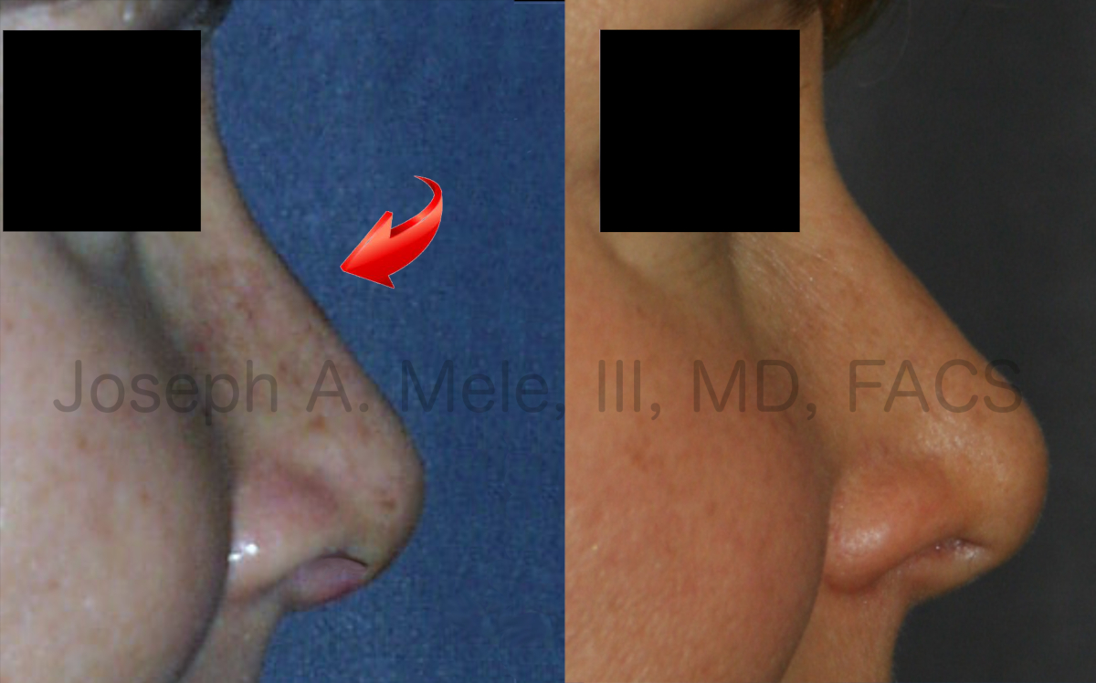 Rhinoplasty recovery photos. The difference between a week and seven years after surgery are shown.