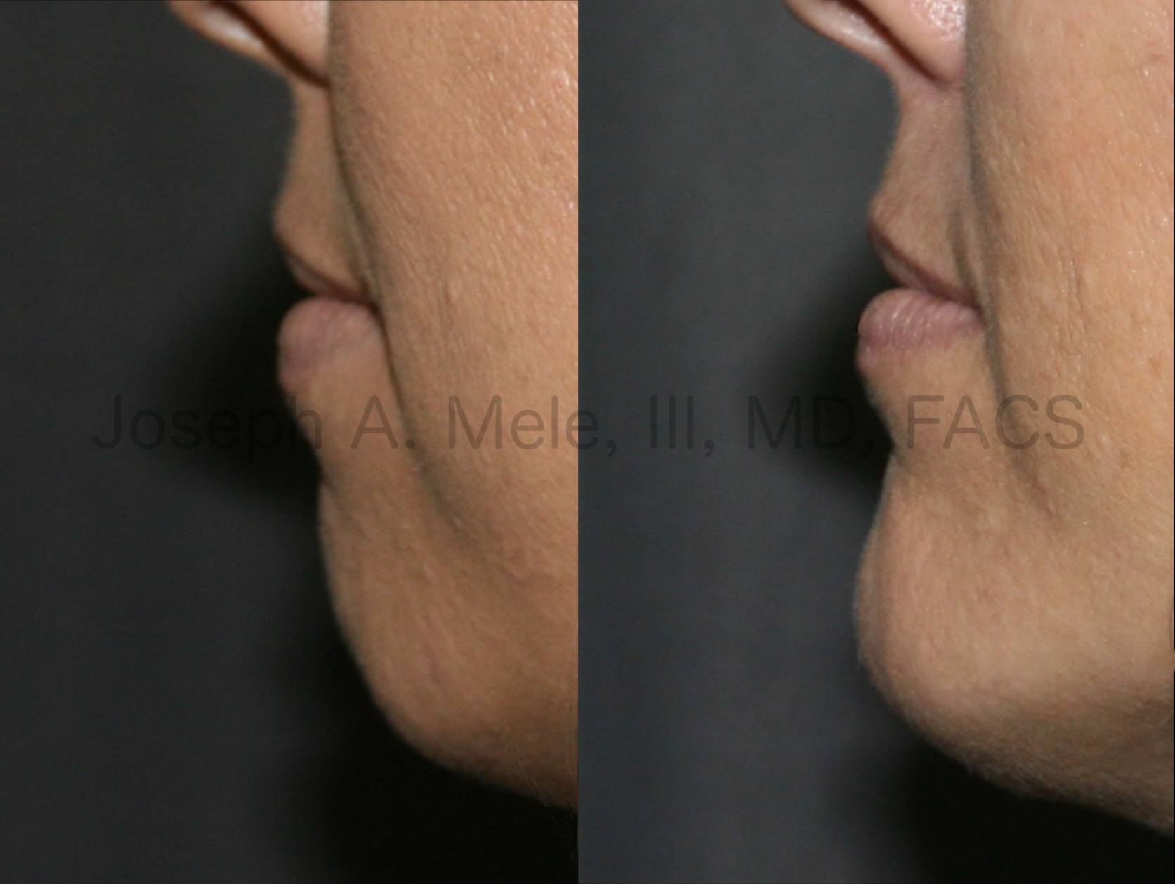 Chin Augmentation before and after pictures (Chin Implant)