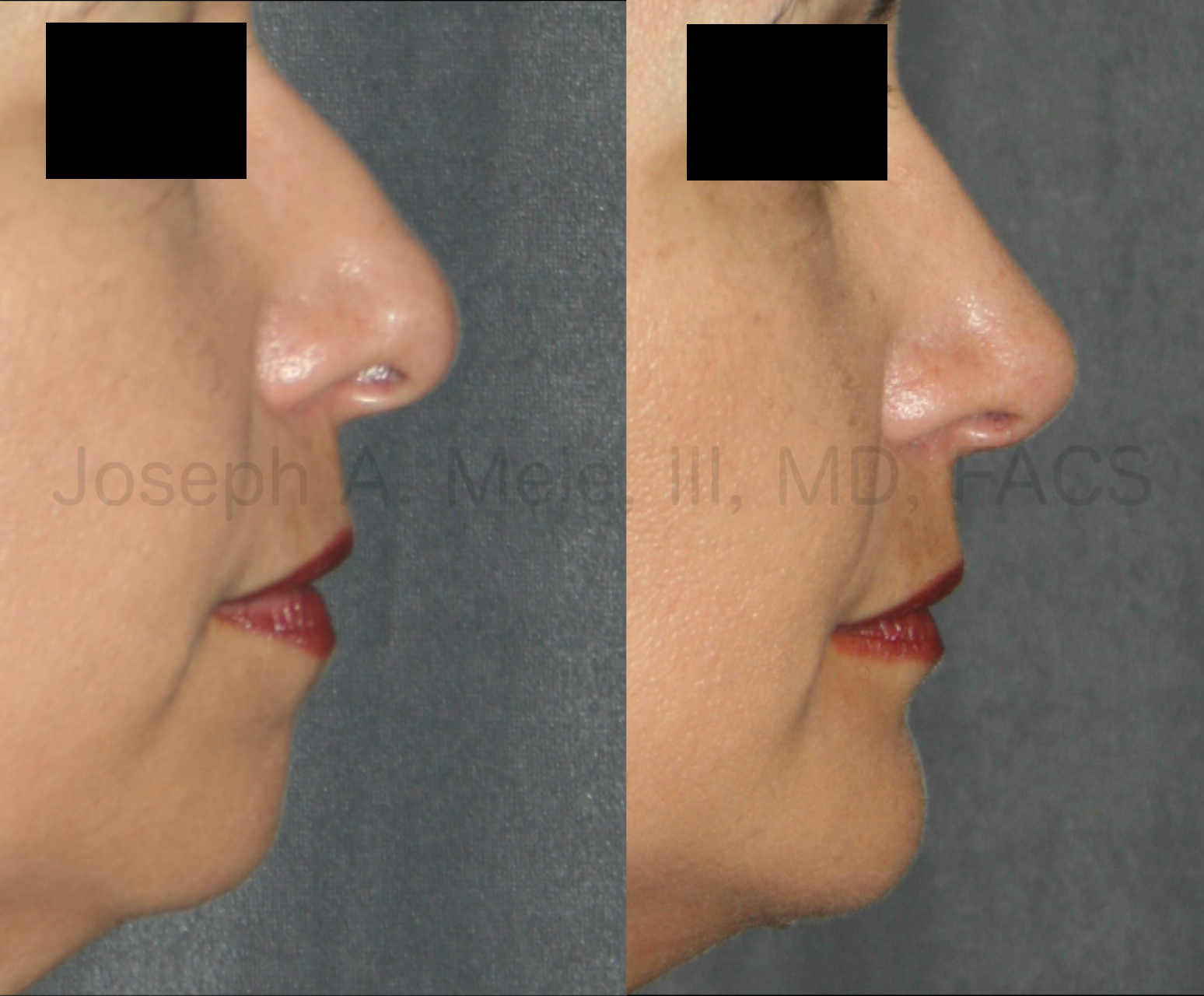 Chin Augmentation with Rhinoplasty before and after pictures