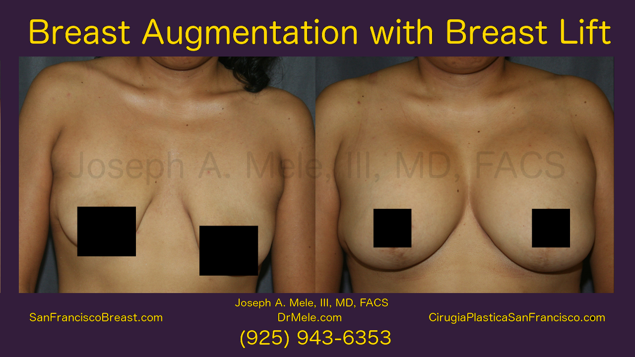 Breast Augmentation Lift Video Presentation with Mastopexy Augmentation before and after pictures