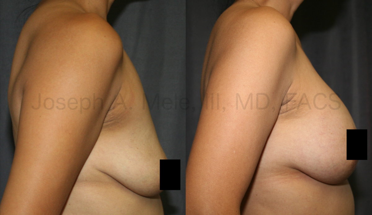 Breast Augmentation Breast Lift before and after pictures (mastopexy augmentation)