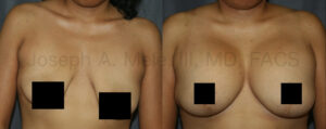 Breast Augmentation Breast Lift before and after pictures (mastopexy augmentation)