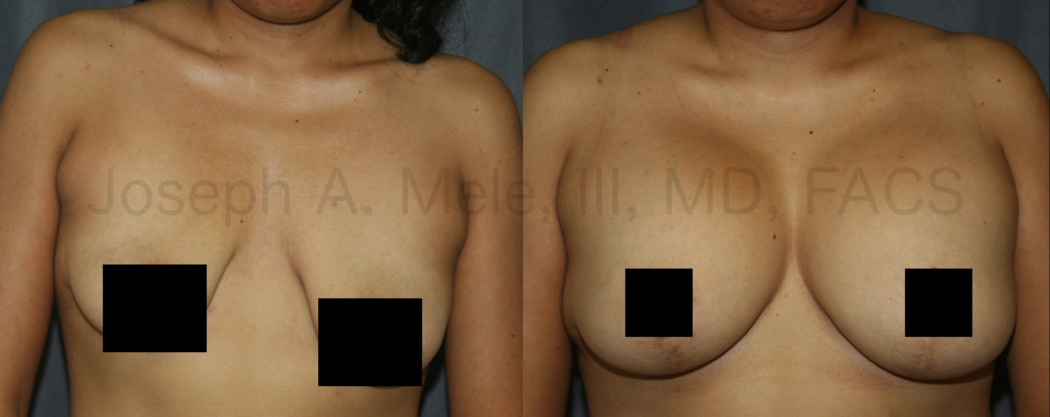 Breast Augmentation Breast Lift before and after pictures (mastopexy augmentation)