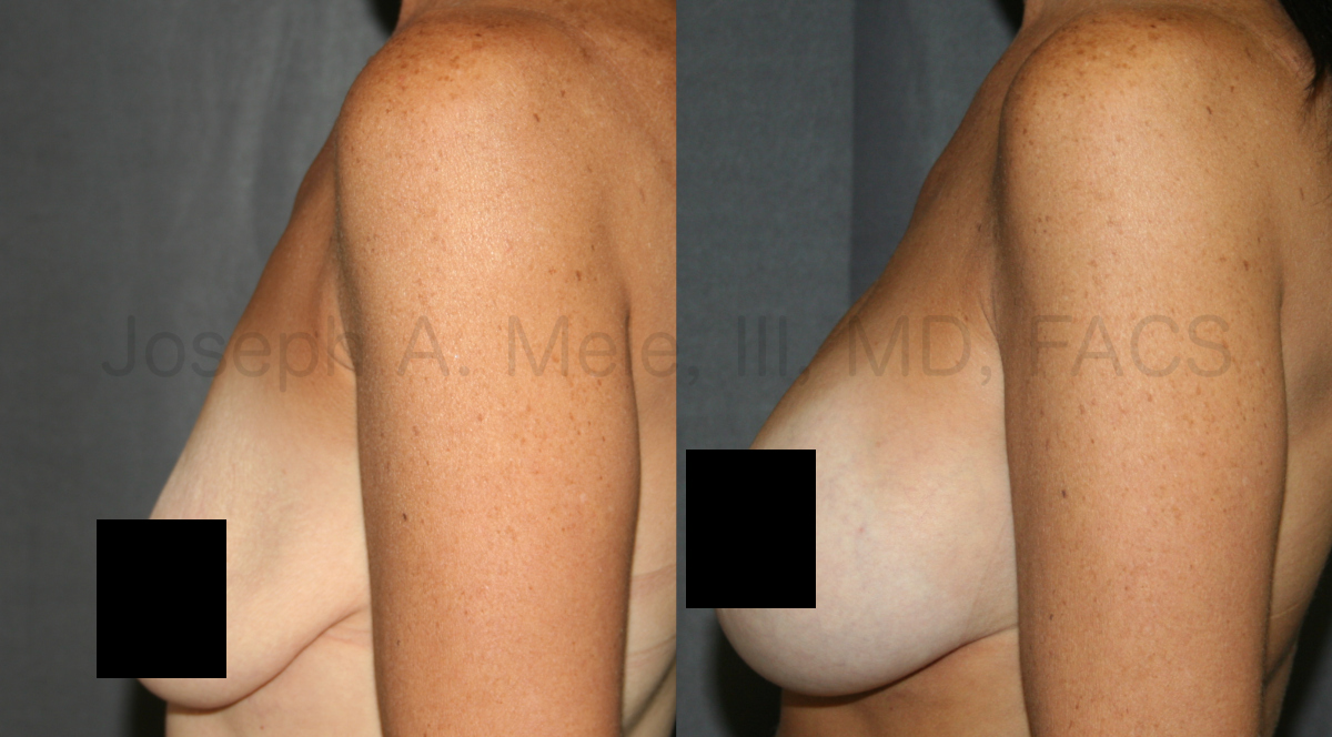 Breast Augmentation Breast Lift before and after pictures (mastopexy augmentation)