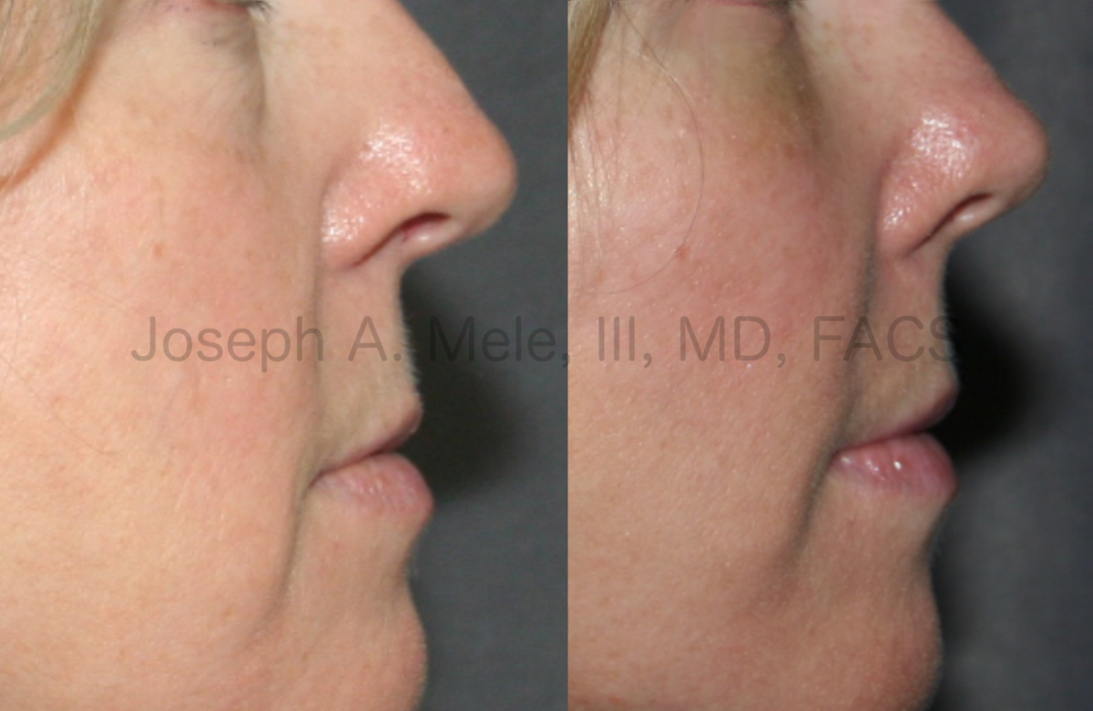 Cheek Augmentation Before and After Pictures