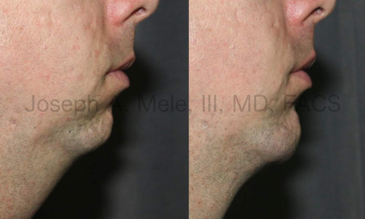 Chin Augmentation Before and After Pictures