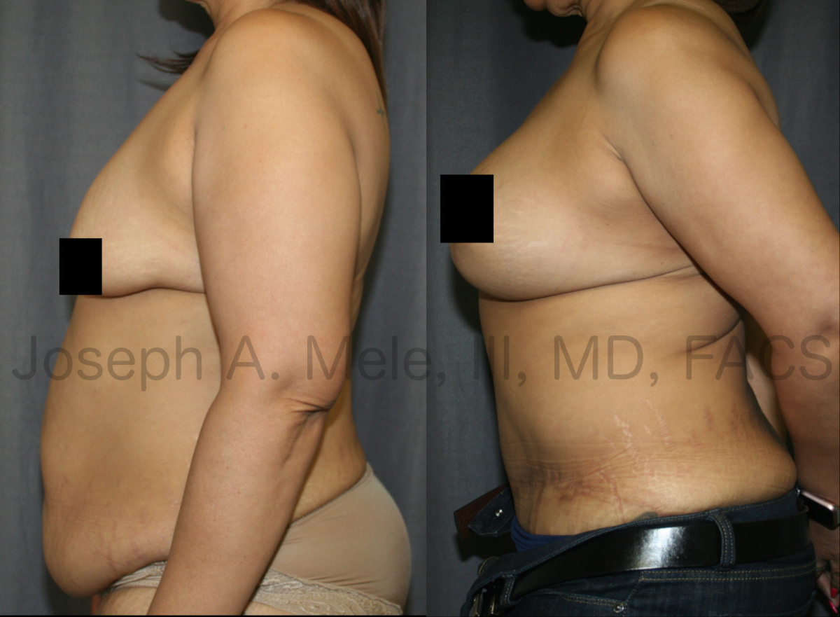 Mommy Makeover with breast augmentation and tummy tuck before and after pictures