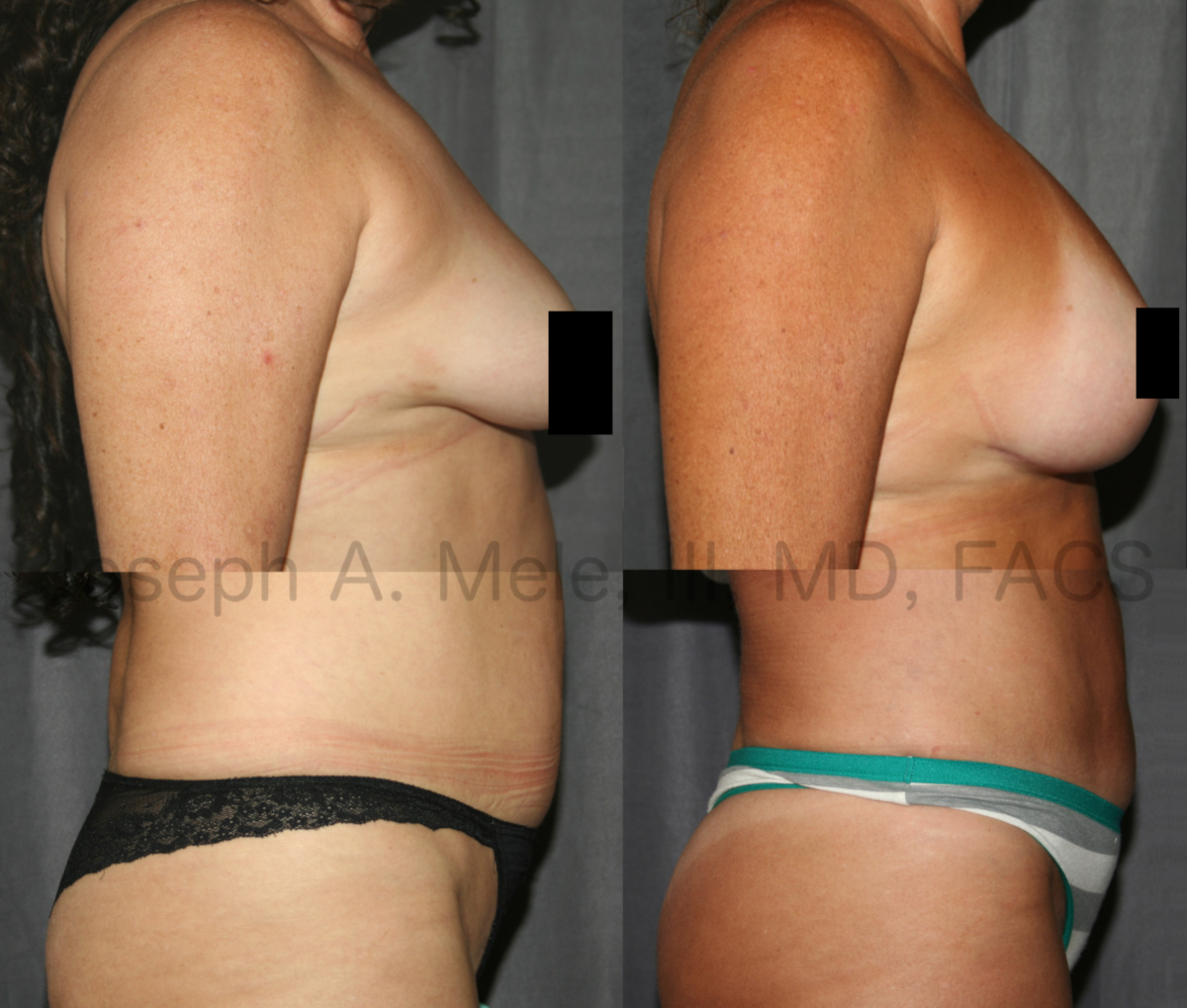 Mommy Makeover with breast augmentation and tummy tuck before and after pictures