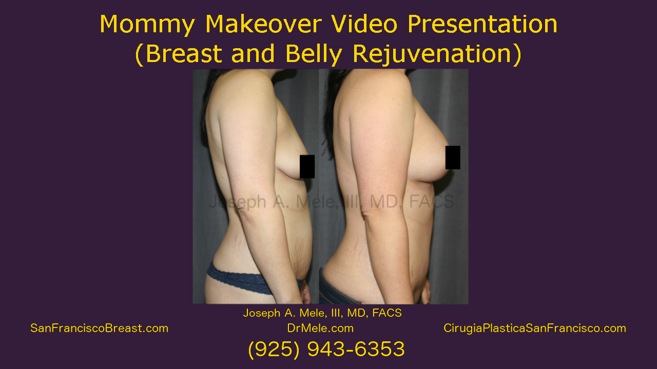 Mommy Makeover Video Presentation with breast augmentation and tummy tuck before and after pictures