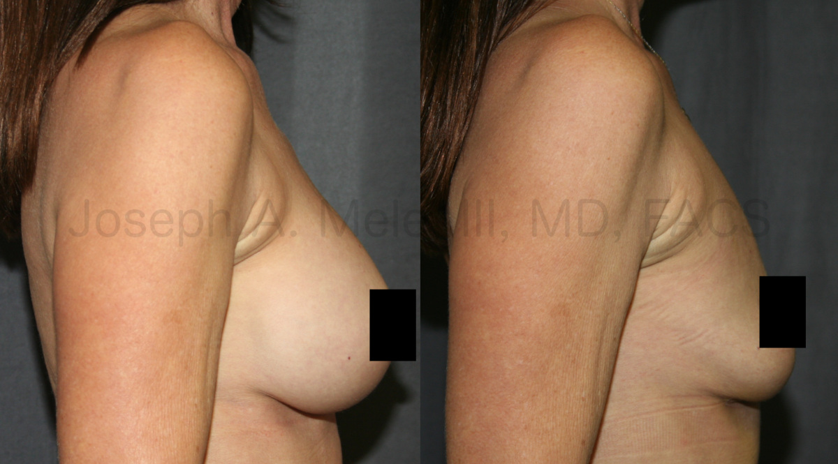Breast Implant Removal Results - One month after surgery