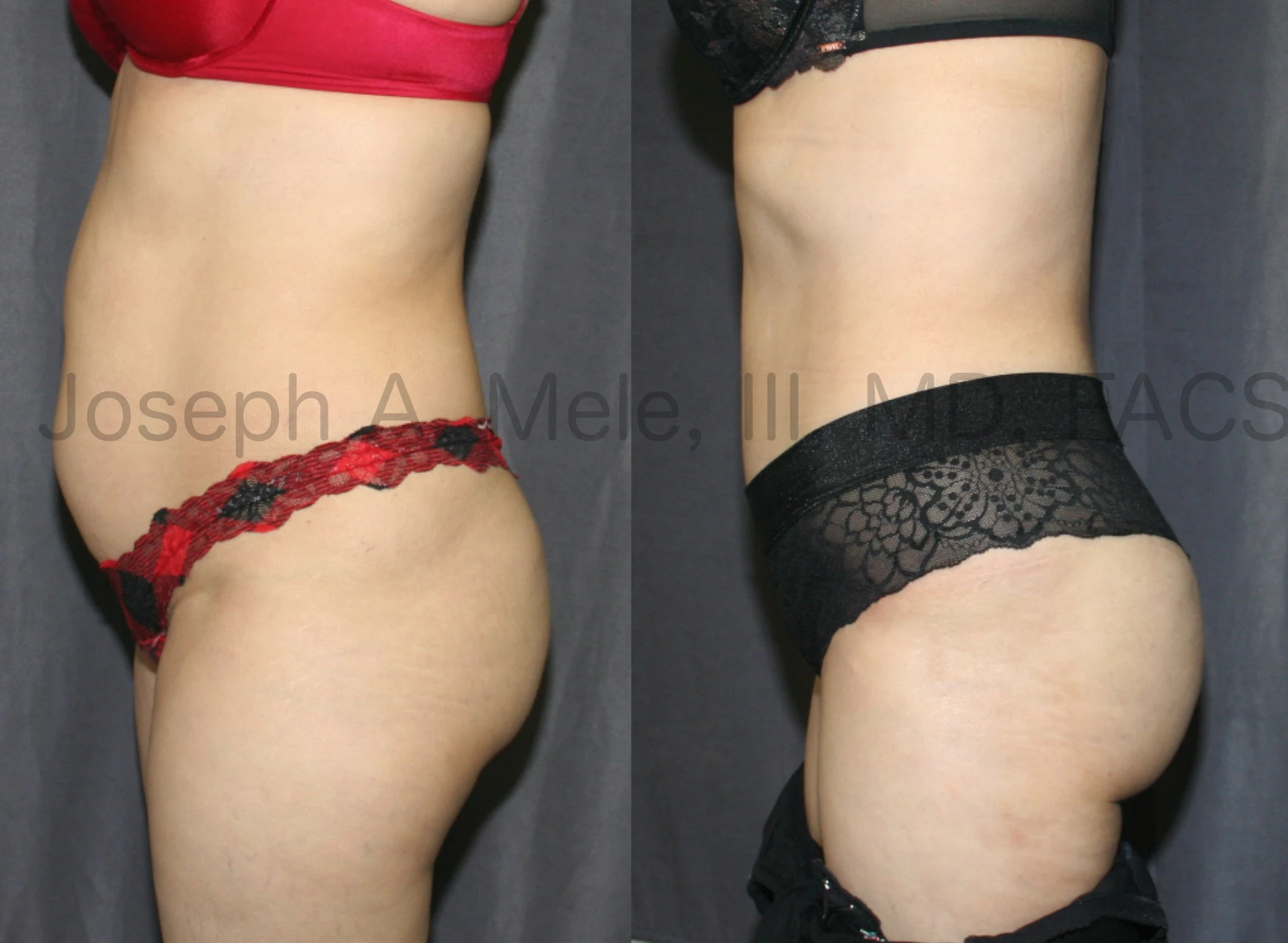 Brazilian Butt Lift and Tummy Tuck before and after pictures (Brazilian Tummy Tuck)