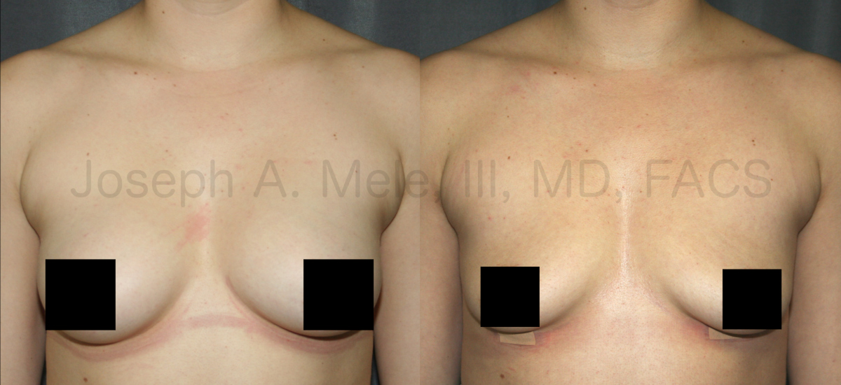 Breast Implant Removal Results - One week after surgery