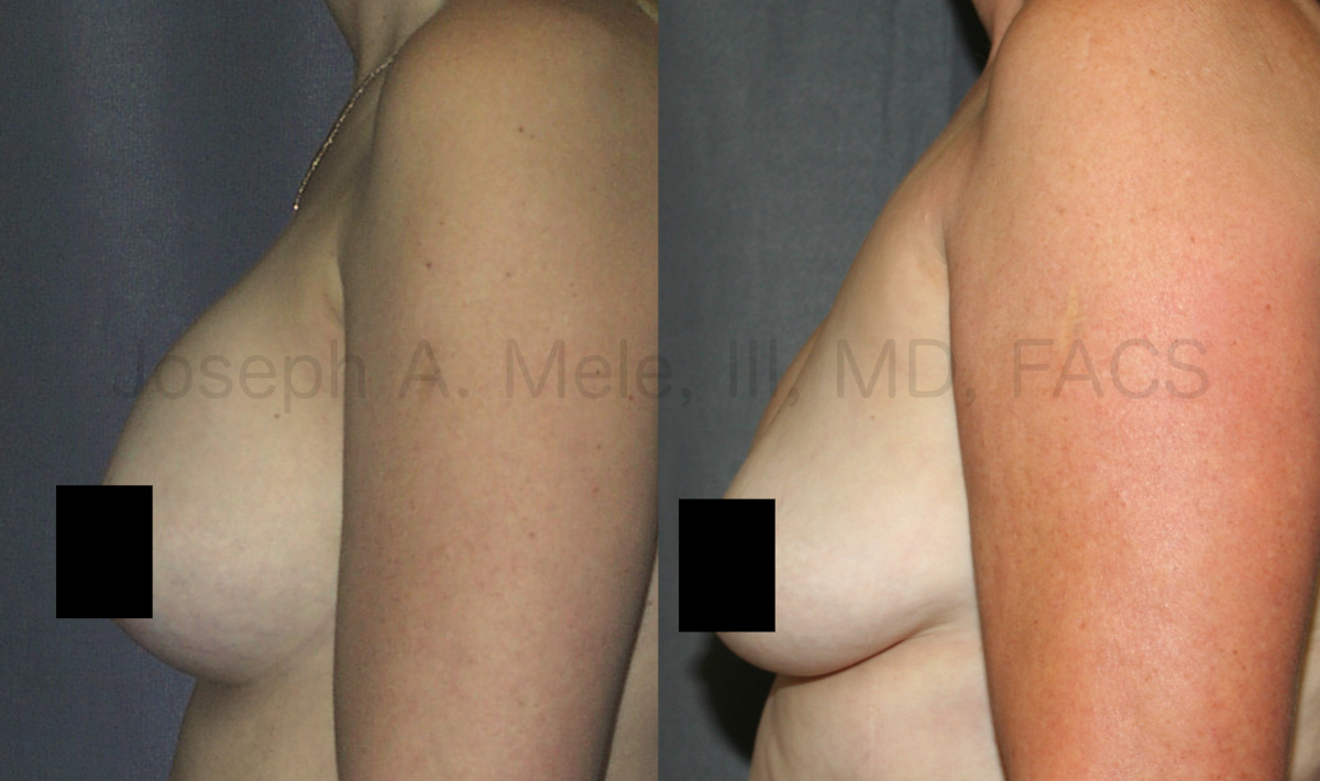 Breast Implant Removal Results - One year after surgery