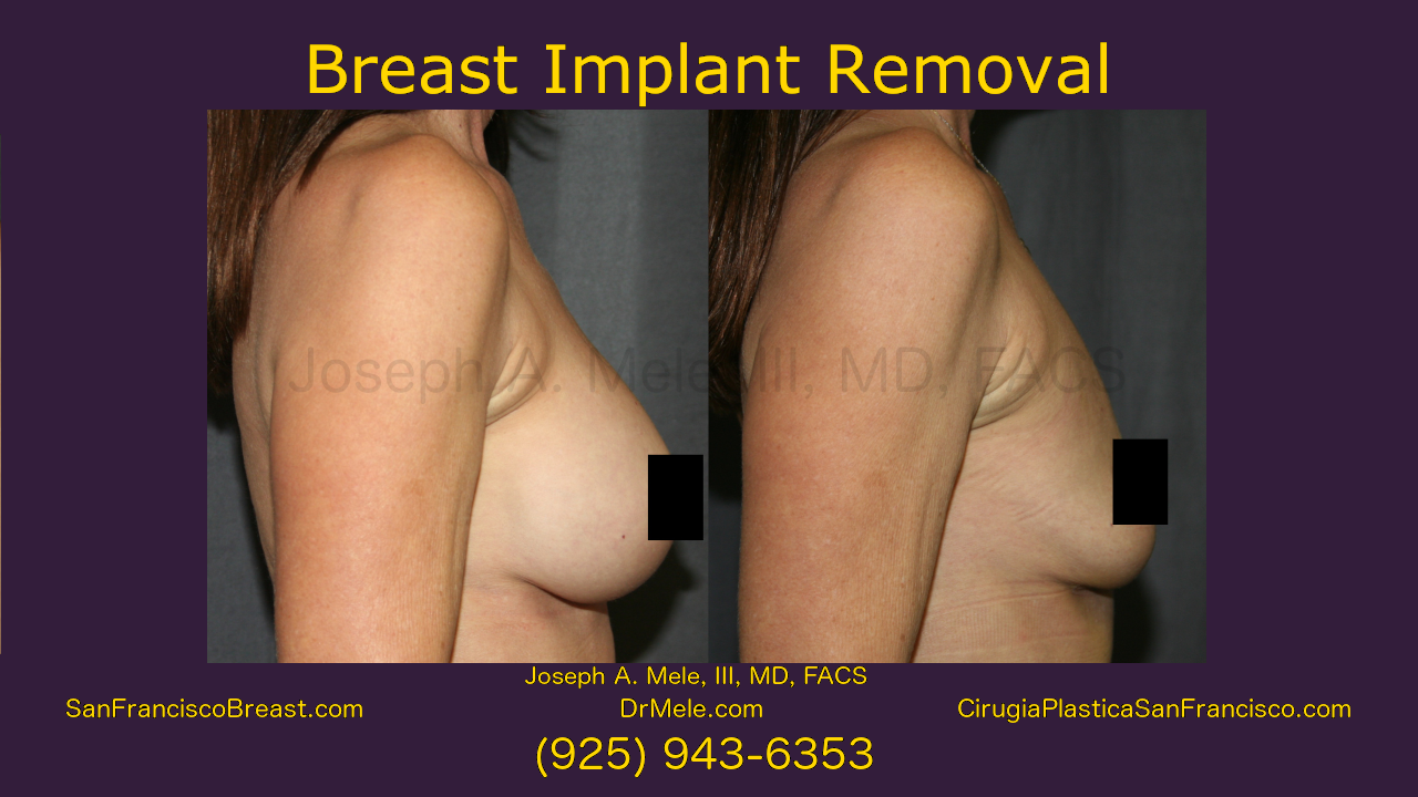 Breast Implant Removal Video Presentation featuring Breast Implant Removal Before and After Pictures