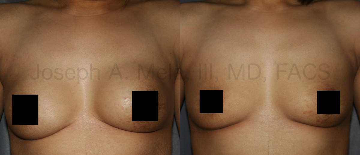 Breast Implant Removal Results - for Capsular Contracture