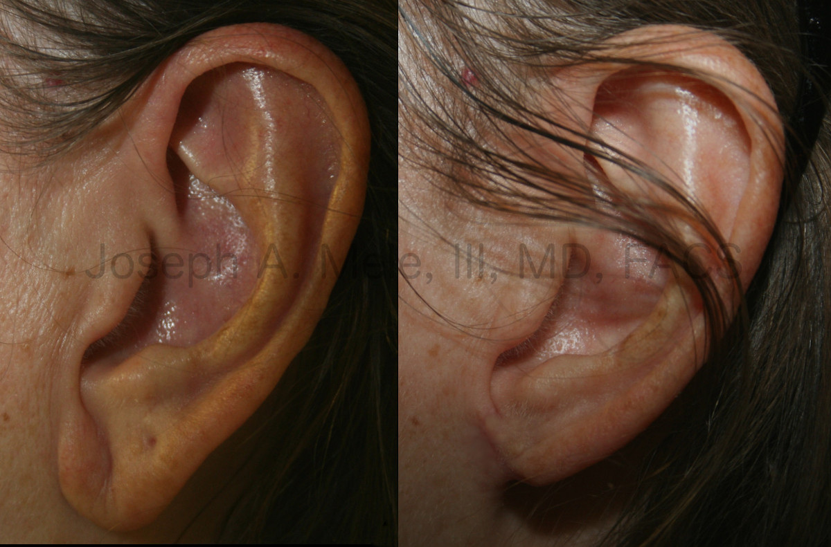 How to Reduce Large Ears and Earlobes - Visage Cosmetic Plastic Surgery