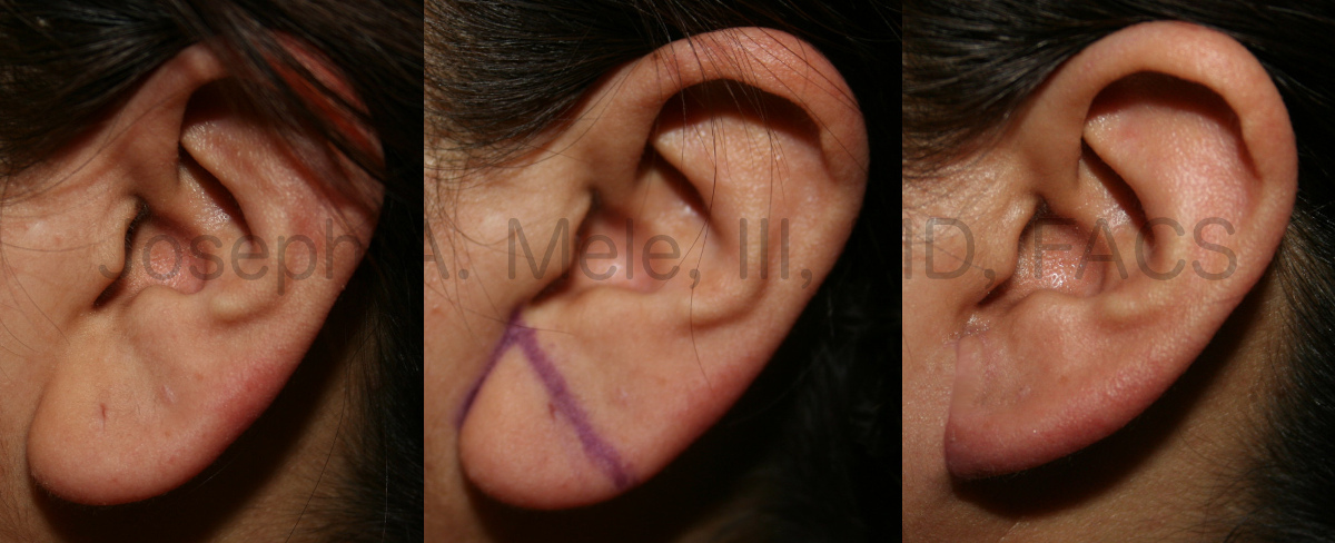 Earlobe Reduction before and after pictures